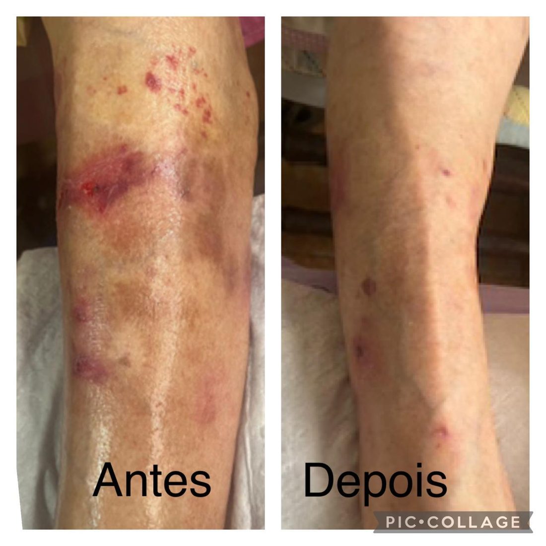 Cicatriz cirúrgica em perna com áreas avermelhadas e endurecidas e, ao lado, a mesma perna em registro posterior com a pele mais uniforme