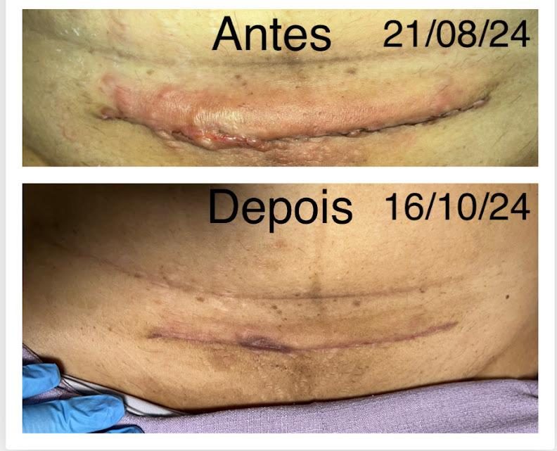Cicatriz de cesárea espessada e avermelhada em agosto de 2024 e a mesma cicatriz em outubro de 2024, mais plana e mais clara